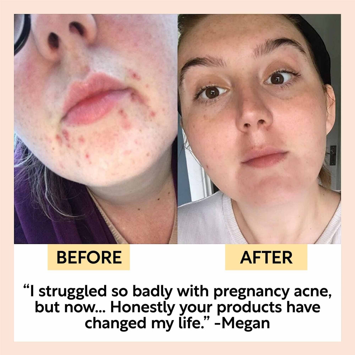 upcircle face moisturiser before and after results showing clear skin improvement for a woman with pregnancy acne